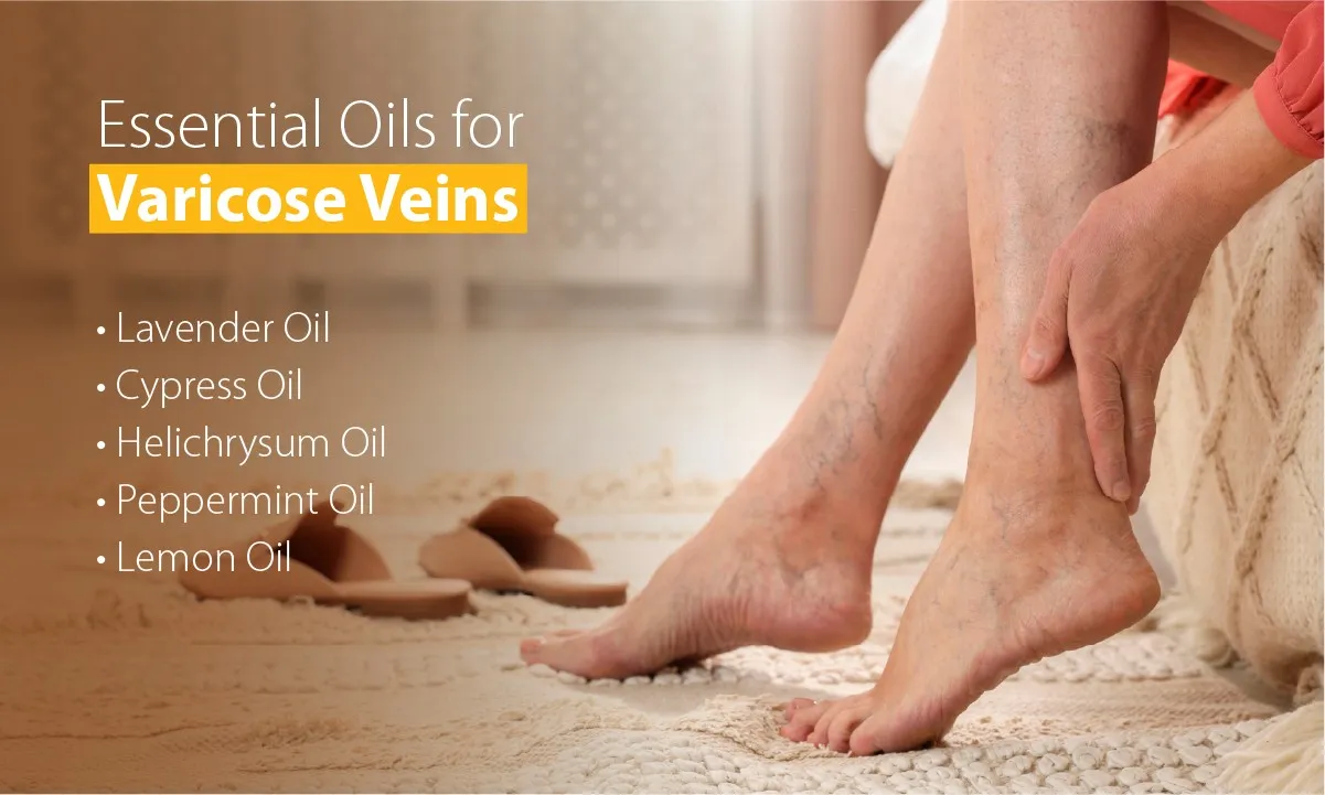 Essential Oils for Varicose Veins